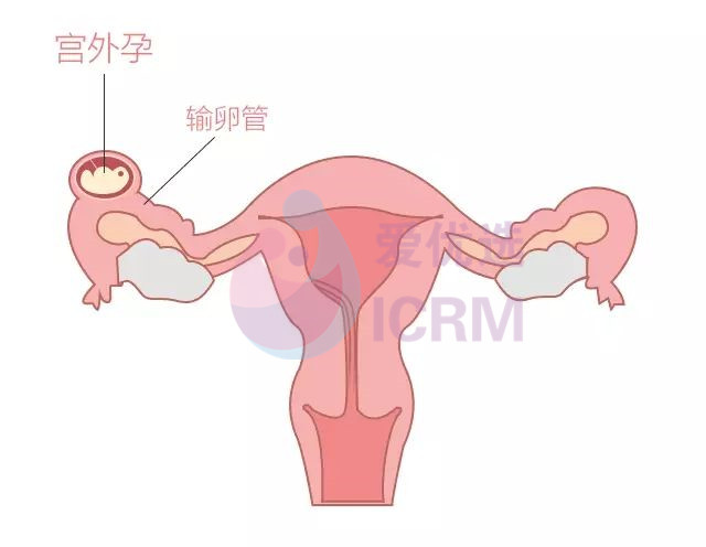 ICRM俄罗斯试管婴儿