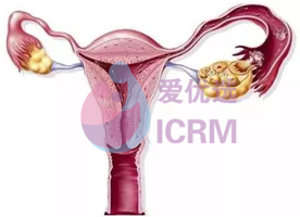 ICRM俄罗斯试管婴儿