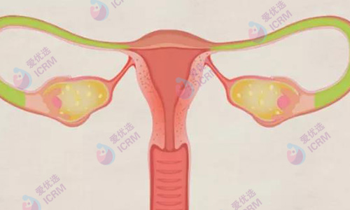 输卵管堵塞做试管婴儿能怀孕吗