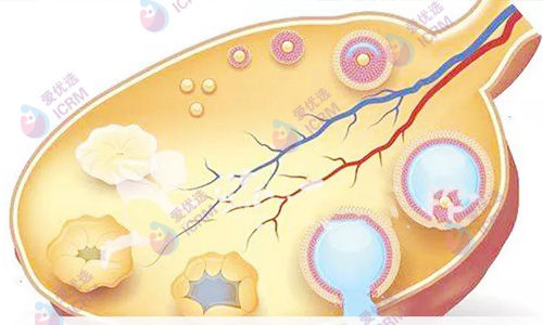 多囊卵巢综合征是如何引起的？可以做试管吗