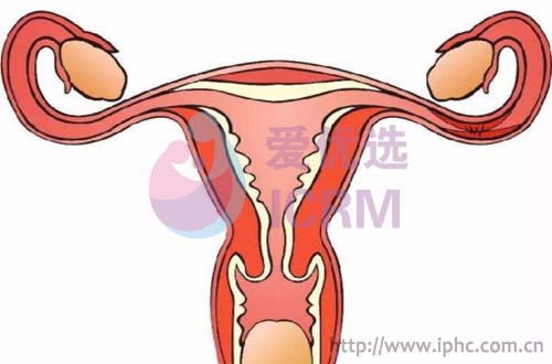 爱优选：女人输卵管堵塞的四大原因
