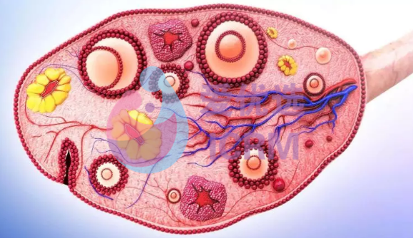 俄罗斯试管婴儿专家解读：7大预警症状自测多囊卵巢综合征